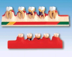 “牙周病分类模型